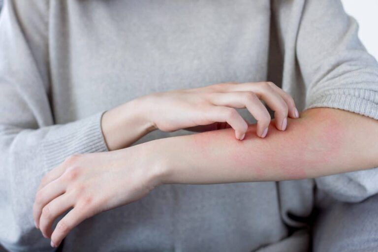 Woman itching rash on her arm.
